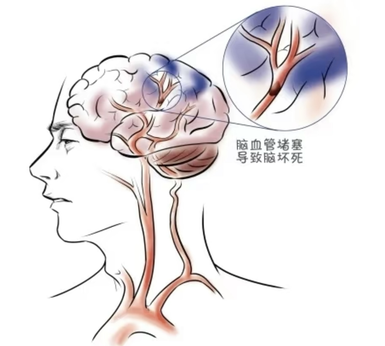 守护生命之河——警惕脑血管狭窄